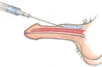 Un método perigoso de ampliación do pene usando inxeccións de vaselina